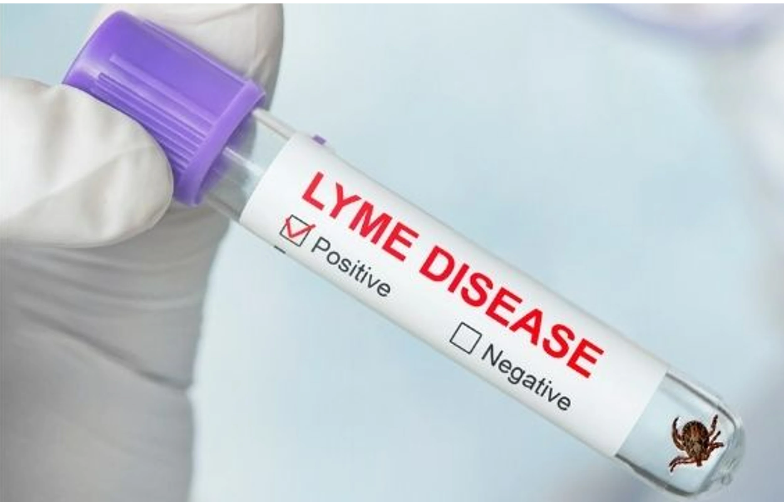 Lyme disease label checked positive on a test tube in the hands of a laboratory assistant