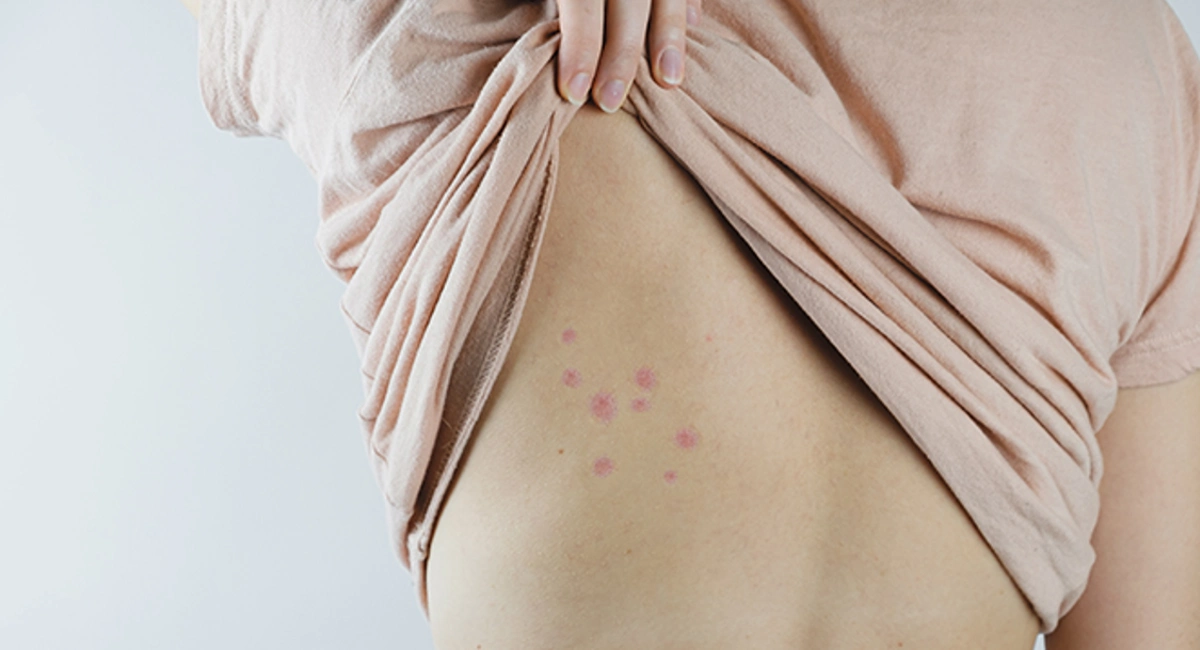 signs of bed bugs
