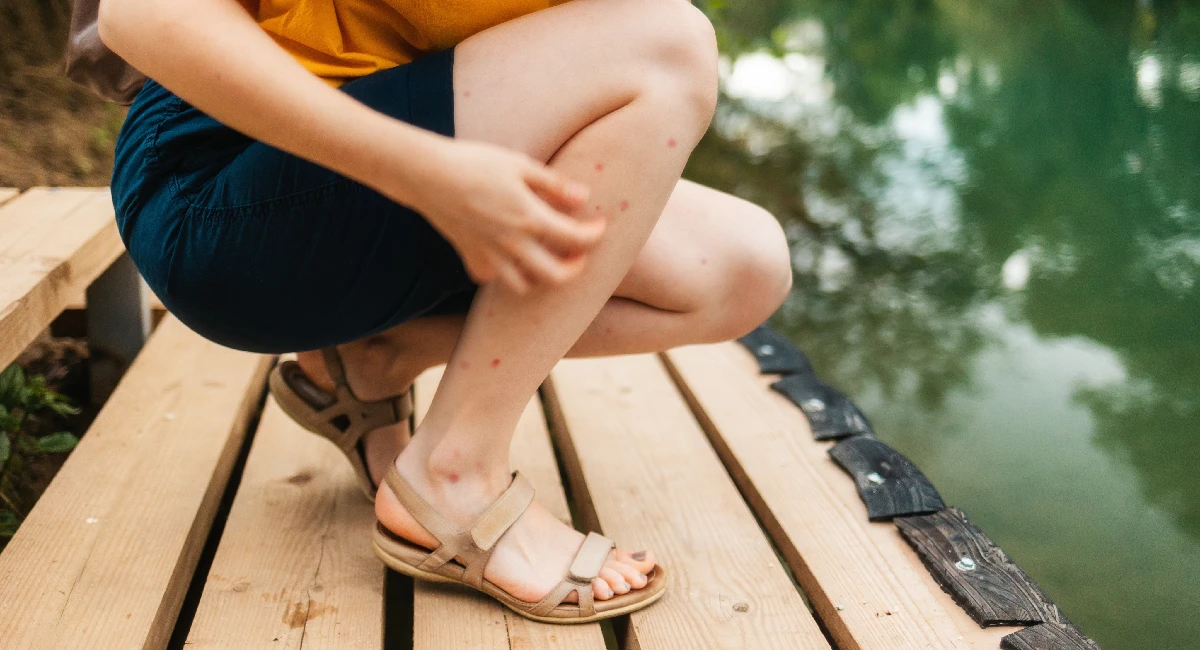 woman scratching a mosquito bite