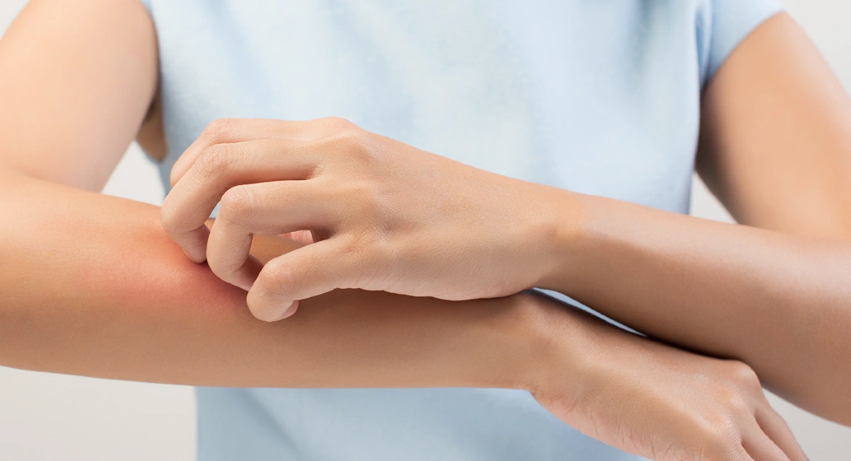 stop mosquito bites from itching