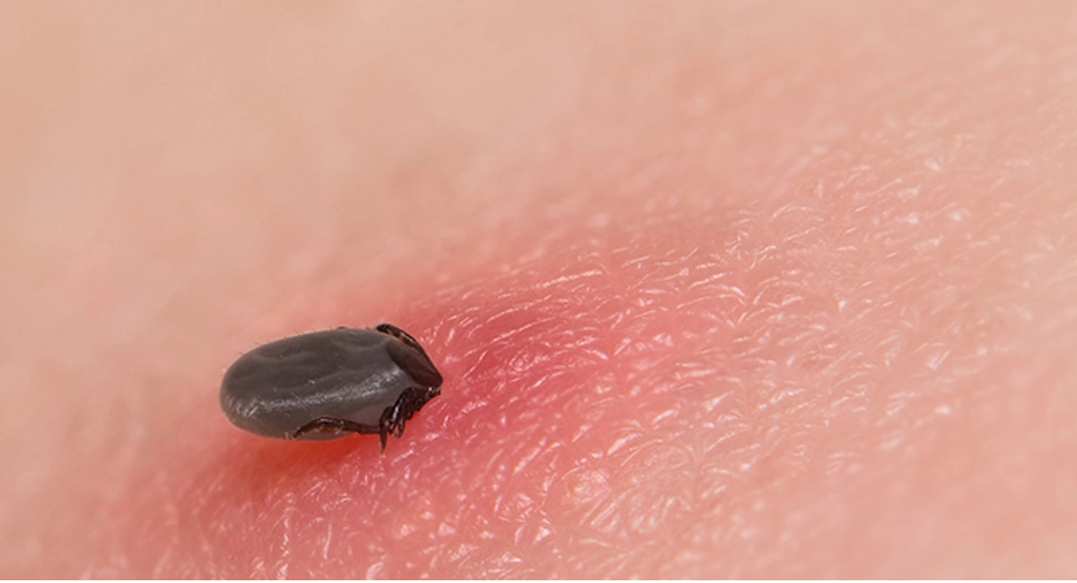 tick bite