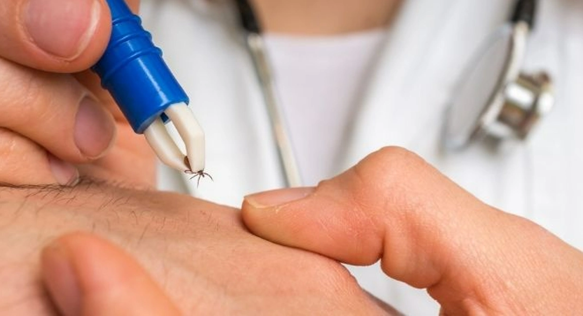 Using white tweezers to properly remove a tick out of human skin